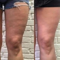 Набір антицелюлітний "Ідеальна шкіра" 3